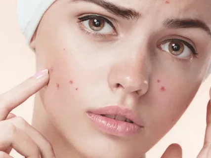 Acne and Inflammation