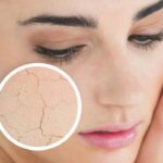 How to Prevent and Treat Dry Skin in Winter