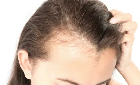 Traction Alopecia