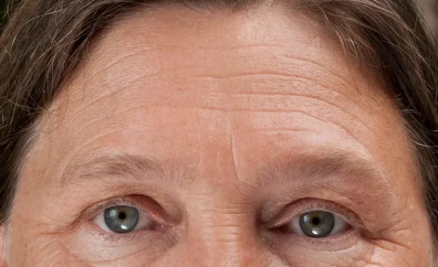 Understanding Fine Lines and Wrinkles