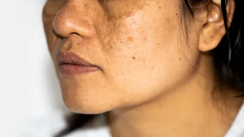 What Are Hyperpigmentation and Dark Spots