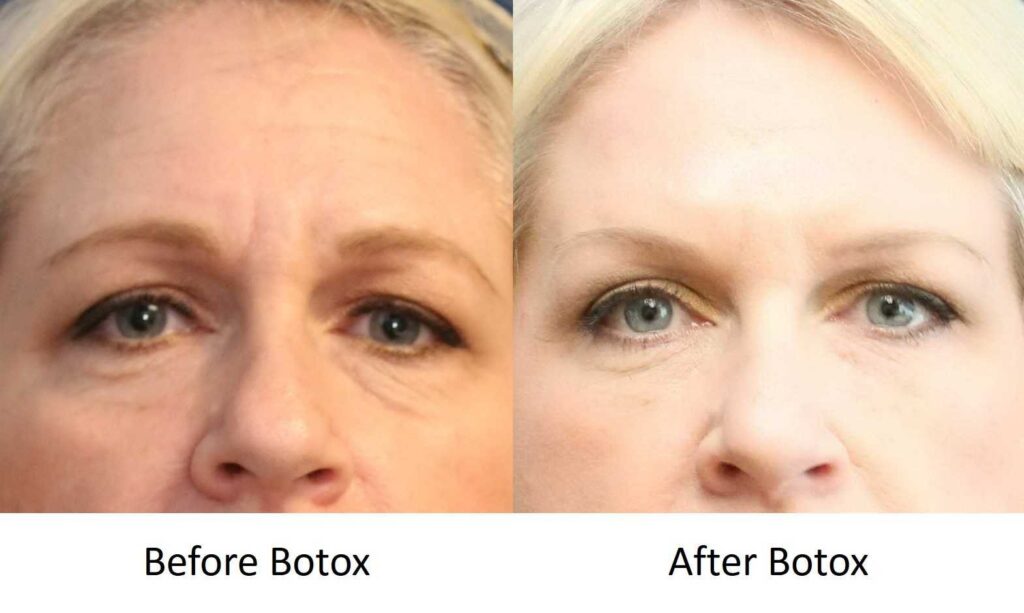 What Is Botox and How Does It Work?