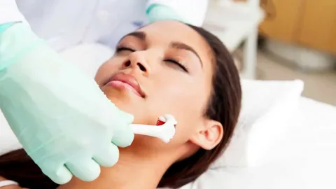 What is Microneedling